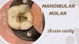 Access opening of Mandibular Molar