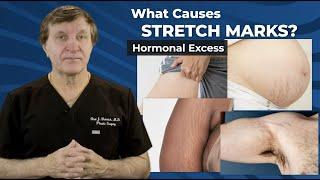 Stretch Marks: Plastic Surgery Hot Topics with Rod J. Rohrich, MD