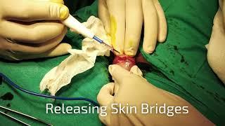 How to repair Penis Skin Bridges?,Stitch less Circumcision Surgery Dr.Sachin Kuber Now +919832136136