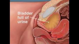 Catheterization Technique for the Urinary Bladder of a Female