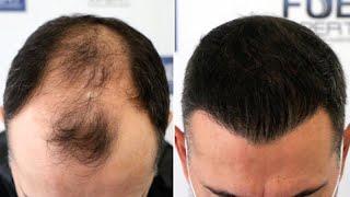 FUE Hair Transplant (3070 Grafts NW V) By Dr Juan Couto - FUEXPERT CLINIC, Madrid, Spain