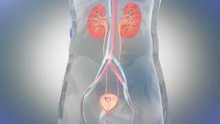 Expel™ Nephroureteral Stent Procedure   Animated Demonstration