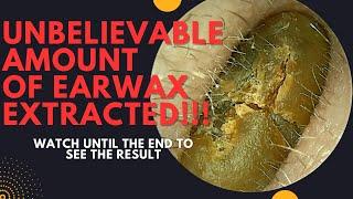 UNBELIEVABLE Amount Of Earwax Extracted From This Ear!!! (Watch Until The End)
