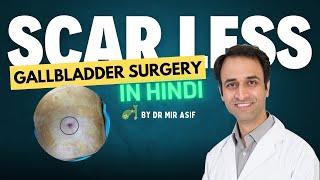 Scarless Cosmetic Gallbladder Surgery: A Revolutionary Procedure by Dr. Mir Asif | Gallstone Surgery