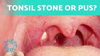 The Difference Between TONSIL STONES and TONSILITIS  (How to Tell Them Apart)