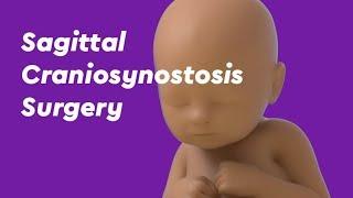 Sagittal Craniosynostosis Surgery