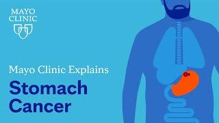 Mayo Clinic explains stomach cancer