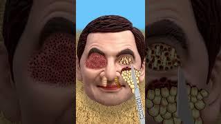 ASMR removing ticks and maggots from Mr Bean | severely injured treatment animation... #asmr