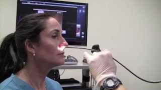 Esophagoscopy Without Sedation (Trans-Nasal Esophagoscopy; Esophagus Exam Endoscopy)