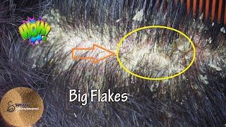 WOW Big Flake? (Crazy Dandruff)!! | Dandruff Scalp Scratching and Picking#92