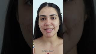 Como esconder manchas de espinhas e melasma com maquiagem | Luana Lemos