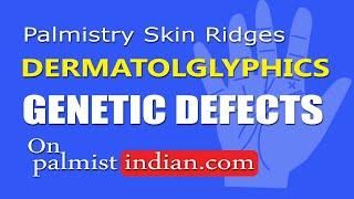 What is Atd angle Palmistry skin ridges count how it might effect genetic defects. incomplete