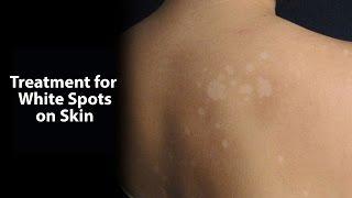 Treatment for White Spots on Skin