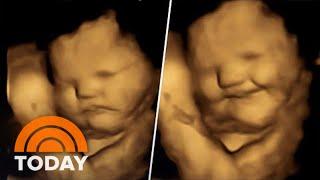 4D Ultrasound Images Show Babies Possible Reaction To Flavors