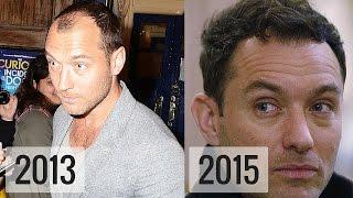 Has JUDE LAW had a HAIR TRANSPLANT?