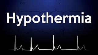 Hypothermia ECG Explained