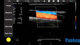 Youkey Wireless Ultrasound clinical video