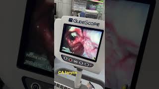 Intubation with video laryngoscope , CALarynx￼ #difficultintubation #intubation