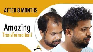 Hair Transplant (4130 grafts NW V) 8 months result by @alloroots