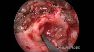 Endoscopic Nasopharyngectomy  | Dr C Rayappa | Head & Neck and Skull Base Surgery