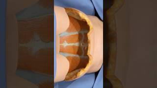 How a tummy tuck removes excess skin (3D Animation)