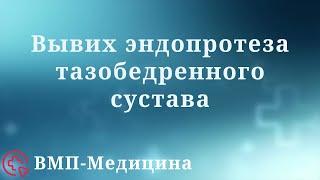 Вывих эндопротеза тазобедренного сустава | ВМП-Медицина