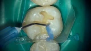 Dr. Randy Shoup: Clinical Video on G-aenial Sculpt