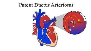 Patent Ductus Arteriosus (PDA)