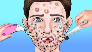 ASMR Giant Acne & Black Head Pimple Removal - Acne Deep Cleaning Animation | ASMR Animation