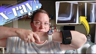 GETTING X-RAYS ON MY ELBOW TO SEE WHAT'S WRONG WITH IT | ELBOW X-RAYS | ELBOW PAIN DIAGNOSIS