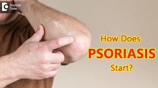 How does psoriasis start? Main Causes & Symptoms - Dr. Chaithanya K S  | Doctors' Circle