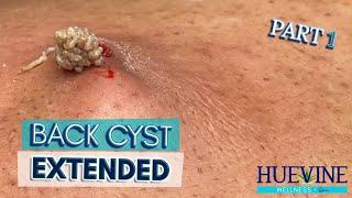 Part 1/3- Massive Back Cyst, Extended | HueVine