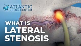 What Is Lumbar Lateral Stenosis? | Foraminal Stenosis