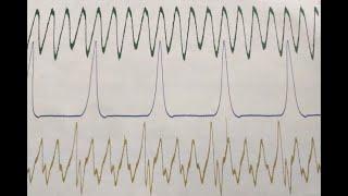 Intake and Exhaust Pressure Waveform Testing for Misfire