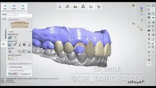 3D - SMILE DESIGN 3shape