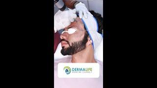 Carbon Laser Facial | A Non-Invasive Treatment | Delhi | Dr. Gaurav Garg #shorts #shortsfeed #delhi