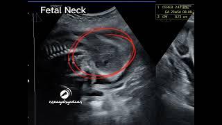 Cardiomegaly