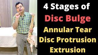 Stages of Disc Bulge, Annular Tear, Disc Protrusion, Disc Extrusion, Herniated Disc Stages