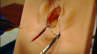 Episiotomy Repair