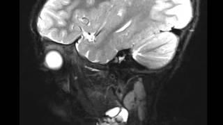 Venolymphatic Malformation