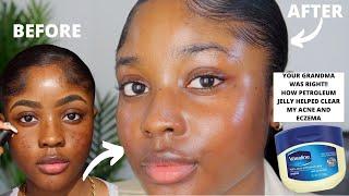 HOW VASELINE HELPED CLEAR MY ACNE AND EZCEMA FASTER!! | KAISERCOBY