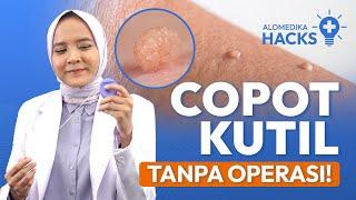 Cara Hilangkan Skin Tag