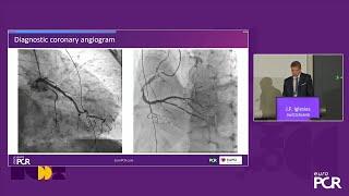 Revisiting thrombus aspiration in STEMI with continuous power aspiration system - EuroPCR