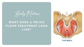 What does a pelvic floor treatment look like?