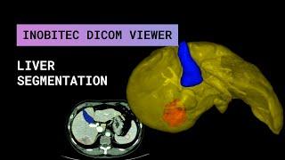 Liver segmentation in Inobitec DICOM Viewer Pro 2.3