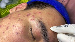 The best acne squeezing collection form Linh Mun Spa part 7