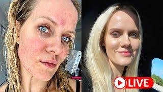 How I cured my ROSACEA naturally