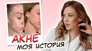 КАК Я ВЫЛЕЧИЛА АКНЕ || УХОД ЗА ПРОБЛЕМНОЙ КОЖЕЙ