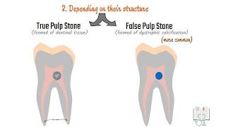 Pulp stones (Denticles) #pulp #dental