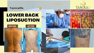 Lower Back Liposuction in Chennai | Tamiralife